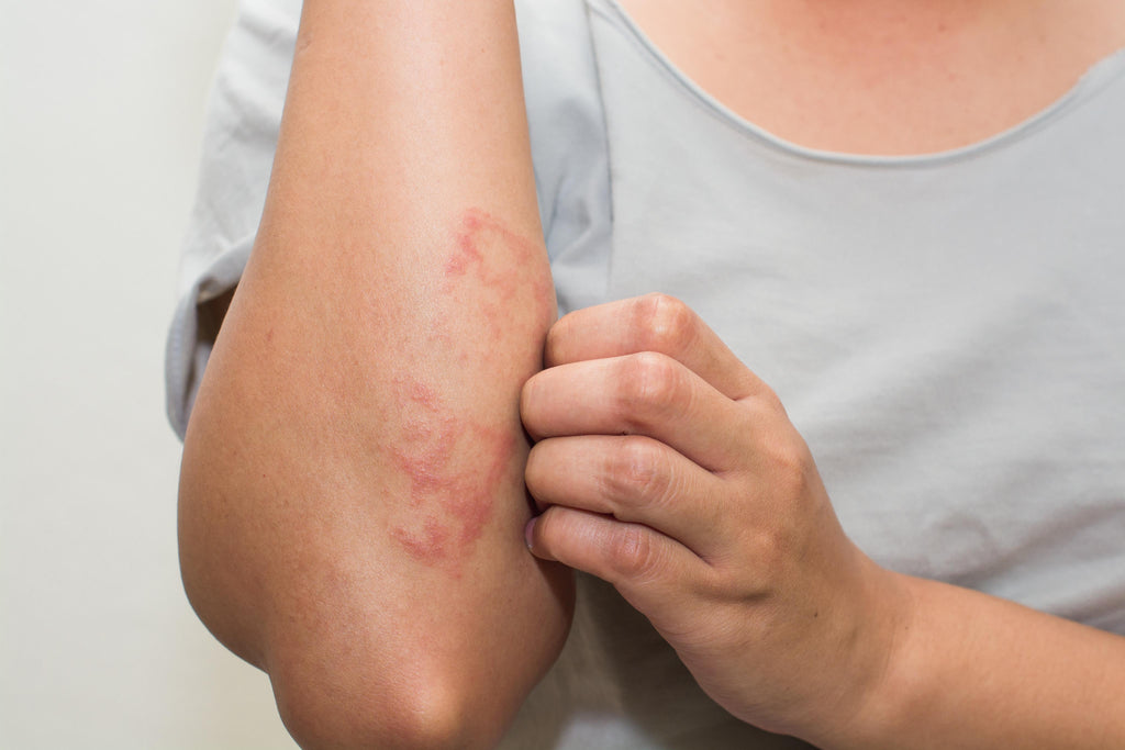 Eczema and other skin problems. Why do they appear?