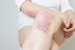 Psoriasis - what is it and how to help the patient