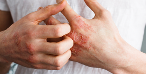 Dermatitis, dry skin and how to live with it
