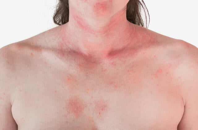 Can allergic rashes be dangerous?