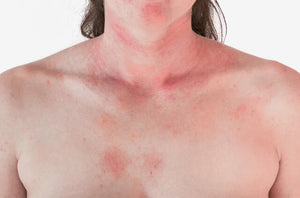 Can allergic rashes be dangerous?