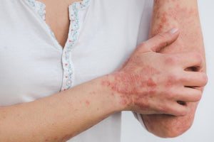 Atopic dermatitis. Basic things the patient needs to know