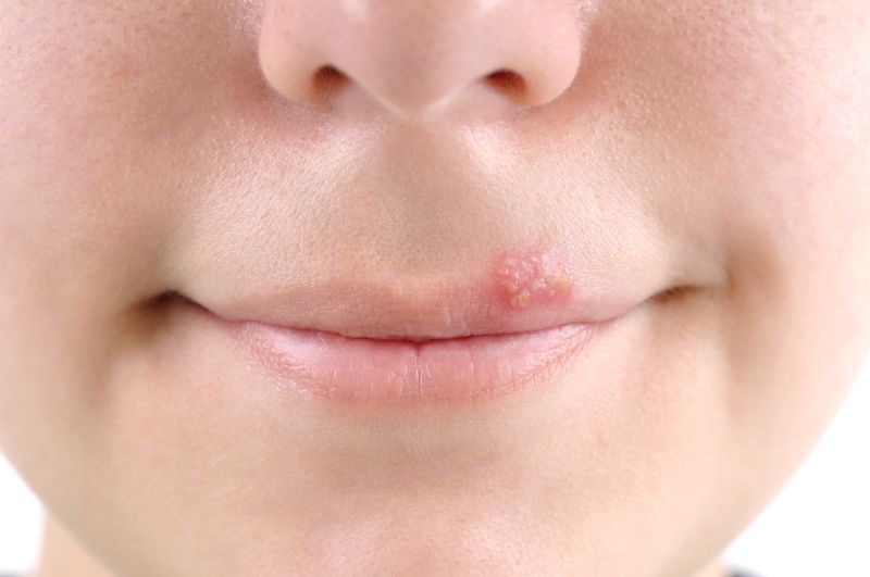 How does herpes affect psychological health?