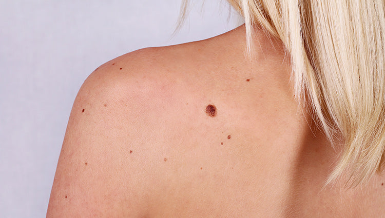 Skin cancer. How can you protect yourself from it?